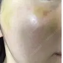 糸リフト ニューセンス皮膚科クリニック DAY 30 サムネイル用