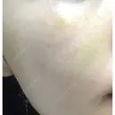 糸リフト ニューセンス皮膚科クリニック DAY 45 サムネイル用
