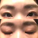 二重切開 / 上まぶたの脂肪取り 松下皮フ形成外科 AFTER サムネイル用