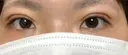 二重埋没 こうべ花時計クリニック DAY 10 サムネイル用