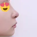 隆鼻術 / 鼻尖形成（切開） / 鼻中隔延長（切開） / 小鼻縮小（切開） / 軟骨移植 / 眉間プロテーゼ / ヒアルロン酸注入（鼻） KAUNIS CLINIC（カウニスクリニック） DAY 9 サムネイル用
