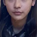 糸リフト / 骨切り（あご） / 脂肪吸引（顔） / ボトックス（エラ・小顔） 銀座マイアミ美容外科 DAY 19 サムネイル用