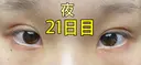 二重埋没 ながしまクリニック DAY 21 サムネイル用