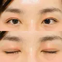 二重切開 郡山タウン形成外科クリニック DAY 64 サムネイル用