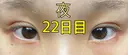 二重埋没 ながしまクリニック DAY 22 サムネイル用