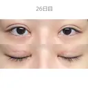 二重切開 / 目頭切開 / 上まぶたたるみ取り サラ美容外科 DAY 26 サムネイル用