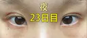 二重埋没 ながしまクリニック DAY 23 サムネイル用