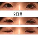 二重埋没 高須クリニック 大阪院 DAY 2 サムネイル用
