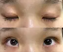 二重埋没 ながしまクリニック DAY 24 サムネイル用