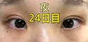 二重埋没 ながしまクリニック DAY 24 サムネイル用