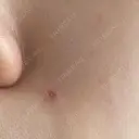 ほくろ・いぼ切除（肌） 大山皮膚科 DAY 7 サムネイル用