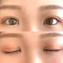 二重切開 EMMA CLINIC（エマクリニック） DAY 59 サムネイル用