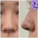 鼻尖形成（切開） / 小鼻縮小（切開） / スレッドノーズ / ヒアルロン酸注入（鼻） キップン整形外科 DAY 7 サムネイル用