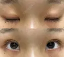 二重埋没 ながしまクリニック DAY 25 サムネイル用