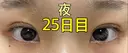 二重埋没 ながしまクリニック AFTER サムネイル用