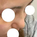 鼻尖形成（切開） / 軟骨移植 / 眉間プロテーゼ 湘南美容クリニック 神戸院 DAY 9 サムネイル用