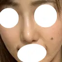 鼻尖形成（切開） / 軟骨移植 / 眉間プロテーゼ 湘南美容クリニック 神戸院 DAY 70 サムネイル用
