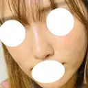 鼻尖形成（切開） / 軟骨移植 / 眉間プロテーゼ 湘南美容クリニック 神戸院 AFTER サムネイル用