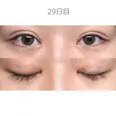 二重切開 / 目頭切開 / 上まぶたたるみ取り サラ美容外科 DAY 27 サムネイル用