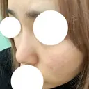 鼻尖形成（切開） / 軟骨移植 / 眉間プロテーゼ 湘南美容クリニック 神戸院 DAY 376 サムネイル用