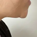 脂肪溶解注射（顔） TCB東京中央美容外科 千葉駅前院 DAY 3 サムネイル用