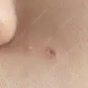 ほくろ・いぼ切除（肌） 大山皮膚科 DAY 9 サムネイル用