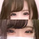 二重埋没 / ヒアルロン酸注入（涙袋） ルラ美容クリニック 新宿院 DAY 107 サムネイル用