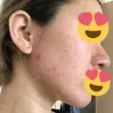 ピーリング（ニキビ・毛穴） / ダーマペン 表参道スキンクリニック 名古屋院（DAILY SKIN CLINIC提携院） DAY 2 サムネイル用