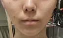 脂肪吸引（顔） Mods Clinic（モッズクリニック） 東京院 DAY 30 サムネイル用