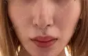 鼻尖形成（切開） 銀座マイアミ美容外科 DAY 15 サムネイル用