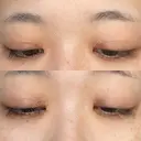 目頭切開 聖心美容クリニック 横浜院 DAY 50 サムネイル用