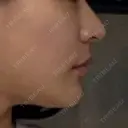 糸リフト / 骨切り（あご） / 脂肪吸引（顔） / ボトックス（エラ・小顔） 銀座マイアミ美容外科 DAY 28 サムネイル用