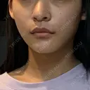 糸リフト / 骨切り（あご） / 脂肪吸引（顔） / ボトックス（エラ・小顔） 銀座マイアミ美容外科 DAY 28 サムネイル用