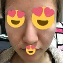 ピーリング（ニキビ・毛穴） / ダーマペン 表参道スキンクリニック 名古屋院（DAILY SKIN CLINIC提携院） DAY 4 サムネイル用