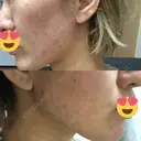 ピーリング（ニキビ・毛穴） / ダーマペン 表参道スキンクリニック 名古屋院（DAILY SKIN CLINIC提携院） DAY 4 サムネイル用