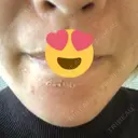 ピーリング（ニキビ・毛穴） / ダーマペン 表参道スキンクリニック 名古屋院（DAILY SKIN CLINIC提携院） DAY 4 サムネイル用