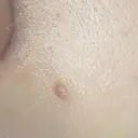 ほくろ・いぼ切除（肌） 大山皮膚科 DAY 13 サムネイル用