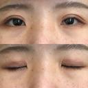 二重切開 城本クリニック 福岡院 DAY 63 サムネイル用