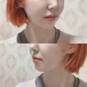 骨切り（あご） / 骨削り（エラ） / 骨削り（頬） id（アイディ）美容外科 DAY 362 サムネイル用