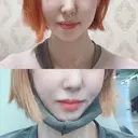 骨切り（あご） / 骨削り（エラ） / 骨削り（頬） id（アイディ）美容外科 AFTER サムネイル用
