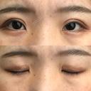 二重切開 城本クリニック 福岡院 DAY 59 サムネイル用