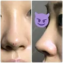 鼻尖形成（切開） / 小鼻縮小（切開） / スレッドノーズ / ヒアルロン酸注入（鼻） キップン整形外科 DAY 6 サムネイル用