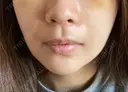 あごプロテーゼ / 鼻翼基部形成（貴族手術） ジョウクリニック 大阪院 DAY 7 サムネイル用