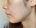 あごプロテーゼ / 鼻翼基部形成（貴族手術） ジョウクリニック 大阪院 DAY 7 サムネイル用