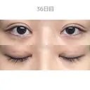二重切開 / 目頭切開 / 上まぶたたるみ取り サラ美容外科 DAY 36 サムネイル用