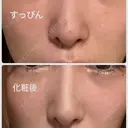 鼻尖形成（切開） 銀座マイアミ美容外科 DAY 21 サムネイル用