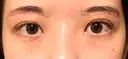 眉下切開 Taide Suenaga Clinic（タイデスエナガクリニック） DAY 76 サムネイル用