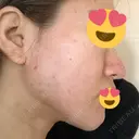 ピーリング（ニキビ・毛穴） / ダーマペン 表参道スキンクリニック 名古屋院（DAILY SKIN CLINIC提携院） DAY 11 サムネイル用