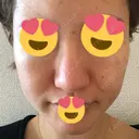 ピーリング（ニキビ・毛穴） / ダーマペン 表参道スキンクリニック 名古屋院（DAILY SKIN CLINIC提携院） AFTER サムネイル用