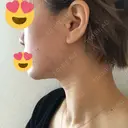 ピーリング（ニキビ・毛穴） / ダーマペン 表参道スキンクリニック 名古屋院（DAILY SKIN CLINIC提携院） DAY 11 サムネイル用